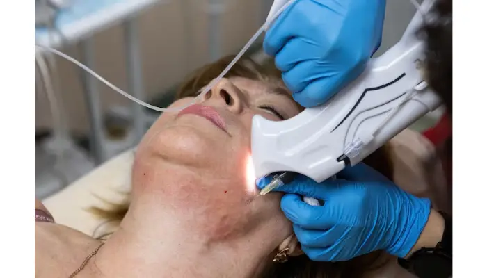 How to Choose a Clinic for Hyperpigment Laser Treatment?