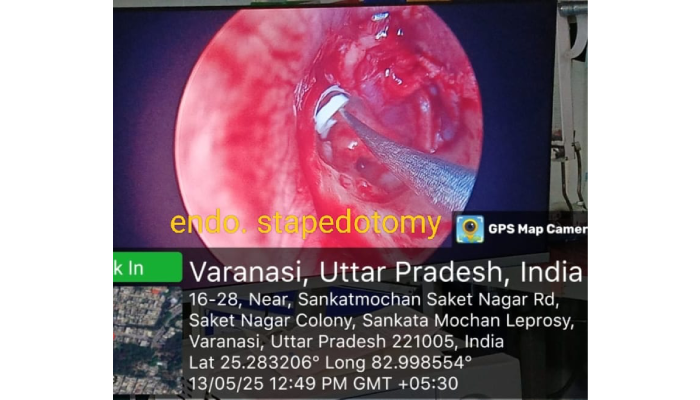 How to Find the Best Clinic for Earwax Removal in Varanasi?