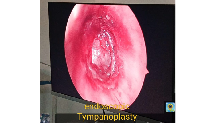 How to Find the Best Clinic for Earwax Removal in Varanasi?